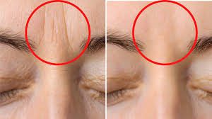 ¿Cómo eliminar las arrugas del entrecejo?