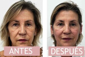 Antes y Después Hifu Liftera paciente Clínica Reabel Antes y Después Hifu Liftera paciente Clínica Reabel