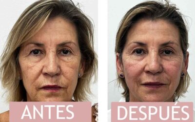 Opiniones sobre HIFU Liftera: Antes y Después de Combatir la Flacidez Facial