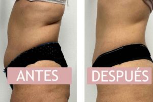 criolipolisis-cintura-antes-y-despues