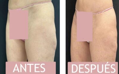 Criolipólisis para Reducir la Grasa en las Caderas. (Antes y Después)
