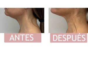 criolipólisis papada o mentón antes y después criolipólisis en papada o mentón antes y después