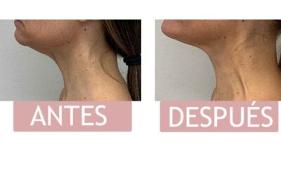 Criolipólisis en el Mentón. (Antes y después)