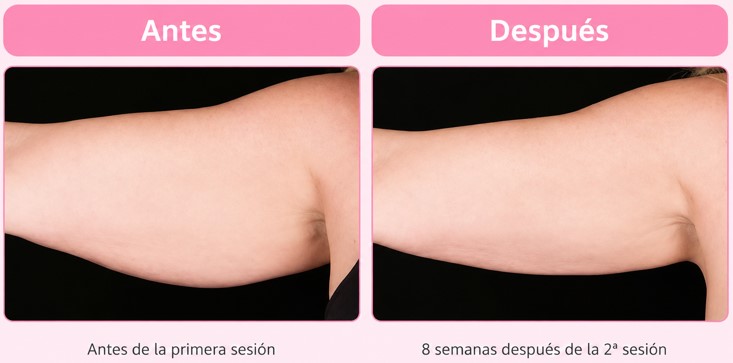 criolipolisis-brazo-antes-y-despues-clinica-reabel