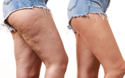 Lipedema: grasa que no desaparece con dieta ni ejercicio